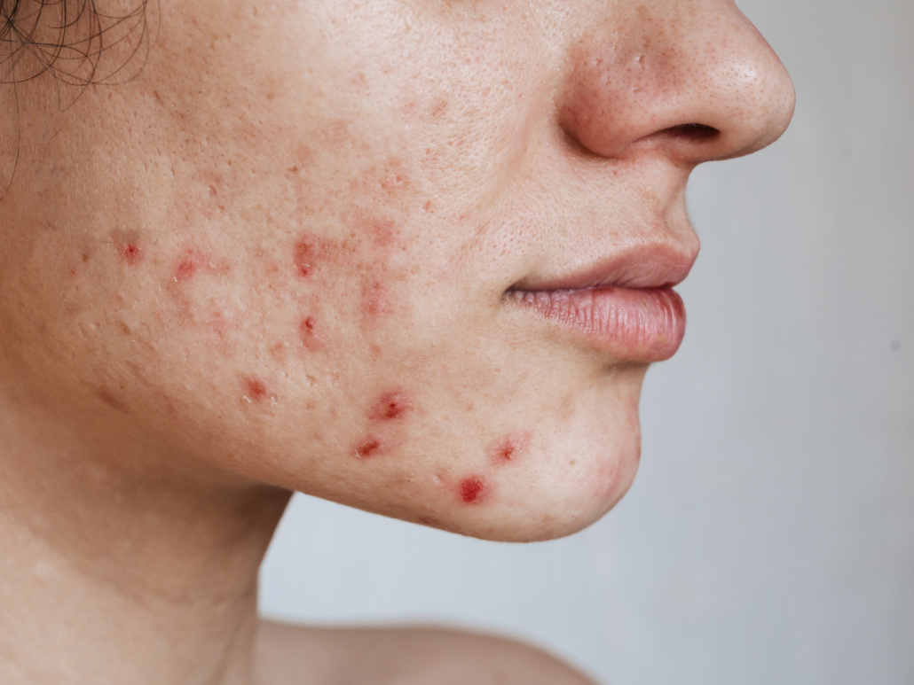 how-to-remove-pimples-and-dark-spots